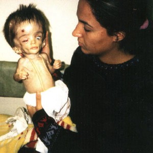 Depleted Uranium Victim