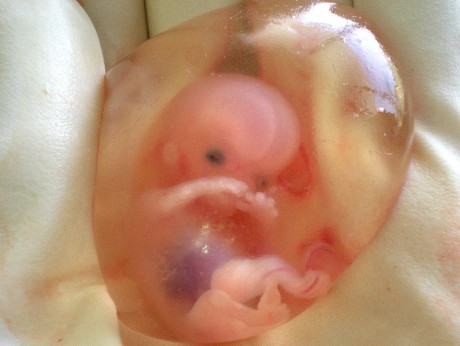 Aborted Baby - Photo by drsuparna